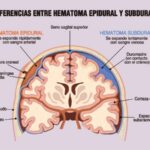 Diferencias Entre Hematoma Epidural Y Subdural